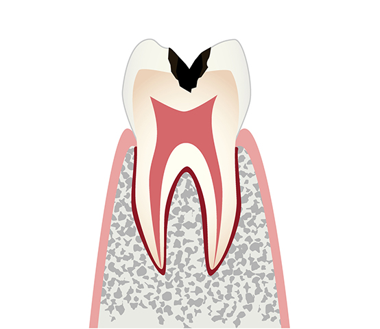 中等度の虫歯（C2）