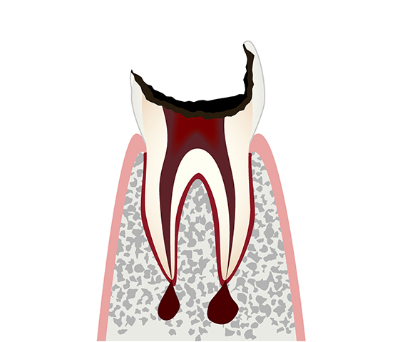 最重度の虫歯（C4）