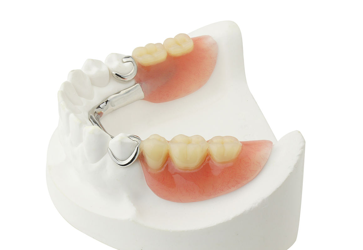 部分入れ歯（部分義歯）