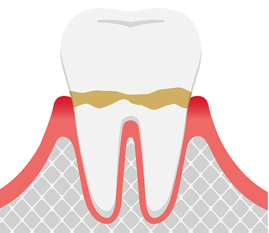 歯肉炎（初期段階）