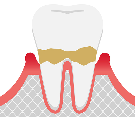 軽度歯周炎